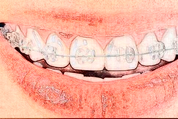 2024天津市第三中心醫(yī)院口腔科隱形矯正價目表(價格表)怎么樣