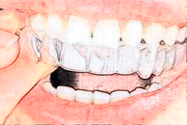 2024天津市第三中心醫(yī)院口腔科隱形矯正價目表(價格表)怎么樣