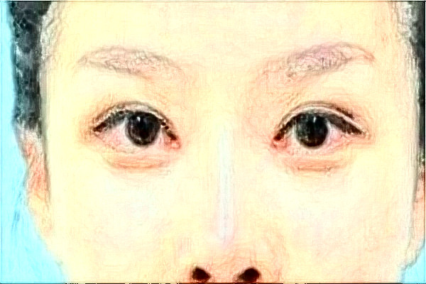 河北省人民醫(yī)院自體脂肪填充面部做的好嗎?真實(shí)案例反饋