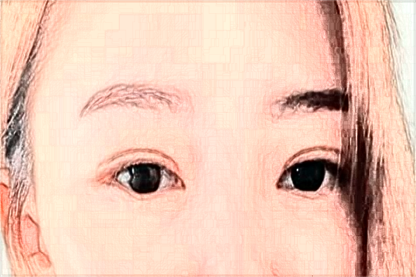 2024寧波李惠利醫(yī)院割雙眼皮怎么樣_案例+價格