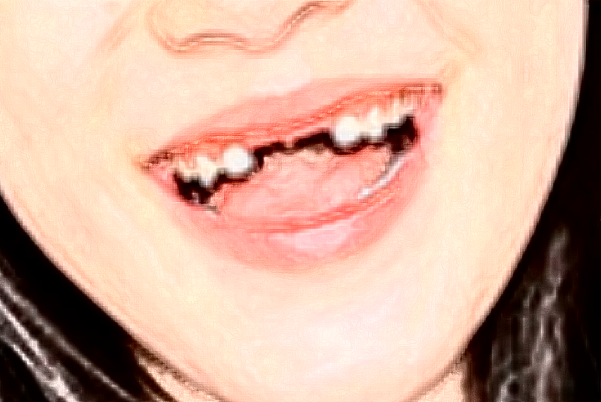 2024河北省人民醫(yī)院口腔科全瓷牙需要多少錢?醫(yī)生推薦