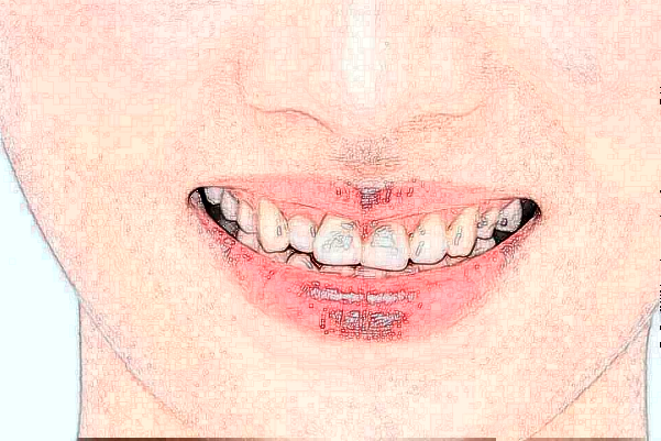 2024河北省人民醫(yī)院口腔科全瓷牙需要多少錢?醫(yī)生推薦