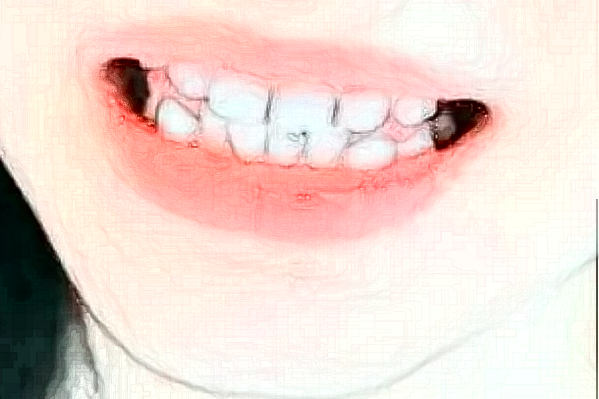 大連大學附屬中山醫(yī)院口腔科拔牙做的好嗎_拔牙整形日記