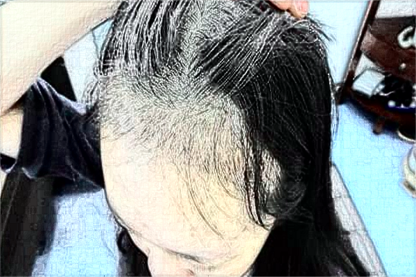 南通大學(xué)附屬醫(yī)院植發(fā)做的好嗎？誰(shuí)做的好