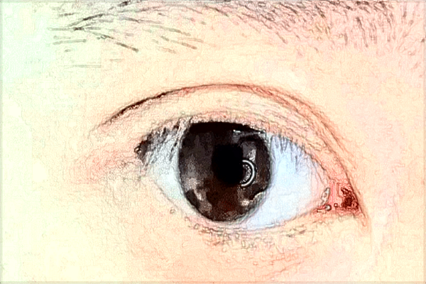 2024中山大學(xué)附屬第三醫(yī)院近視手術(shù)多少錢?近視手術(shù)有風(fēng)險(xiǎn)嗎