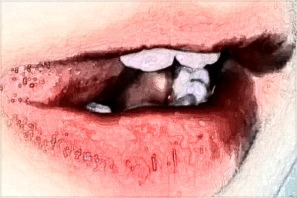 2024中山大學附屬第三醫(yī)院全口假牙費用?全口假牙能用多長時間