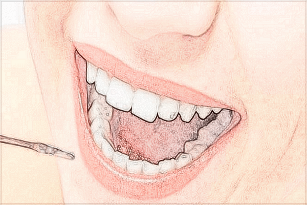 2024武漢大學口腔醫(yī)院烤瓷牙價格?烤瓷牙怎么樣?