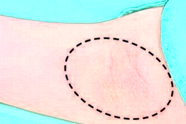 2024無(wú)錫市第一人民醫(yī)院去狐臭怎么樣_整形日記分享