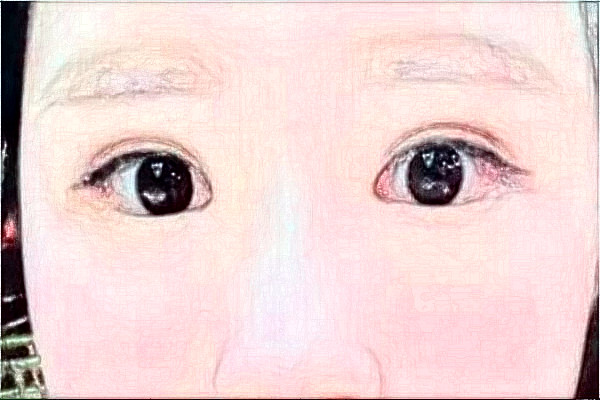 2024南京鼓樓醫(yī)院去眼袋怎么樣_體驗(yàn)日記分享