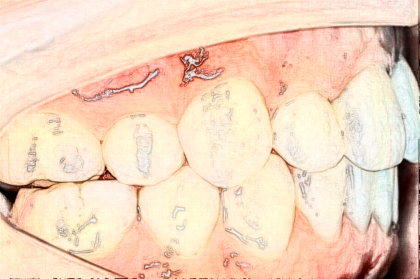 南通大學(xué)附屬醫(yī)院隱形正畸做的好嗎？誰做的好