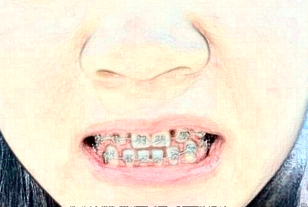 天津醫(yī)科大學(xué)第二醫(yī)院口腔科正畸怎么樣_哪個醫(yī)生比較好