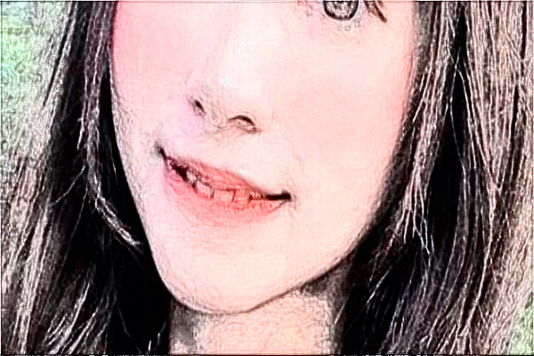 安徽省立醫(yī)院玻尿酸價格多少?貴不貴