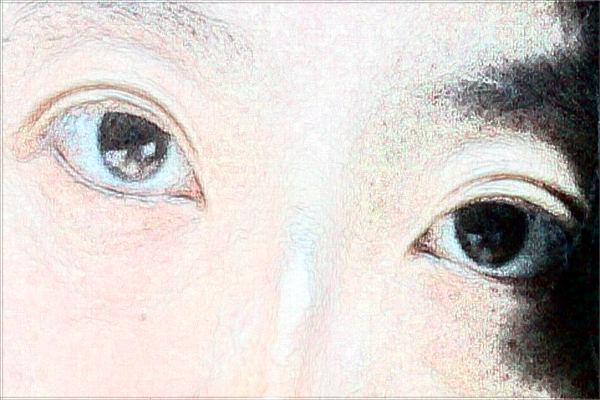 天津市醫(yī)科大學(xué)眼科醫(yī)院近視怎么樣_整形日記分享