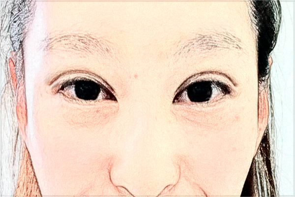 天津市醫(yī)科大學(xué)眼科醫(yī)院近視怎么樣_整形日記分享