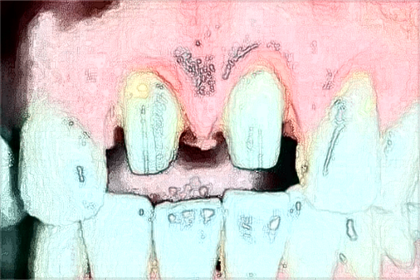 2024青島市立醫(yī)院拔智齒怎么樣?拔智齒收費價目表