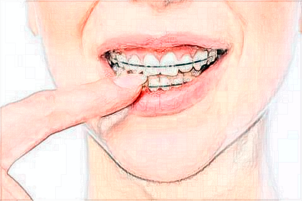 2024中山大學附屬第五醫(yī)院牙齒美白好嗎?牙齒美白價格