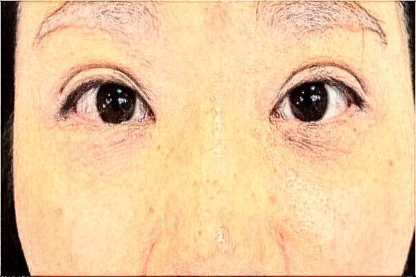 2024天津市醫(yī)科大學(xué)眼科醫(yī)院全飛秒做的好嗎?誰(shuí)做得好