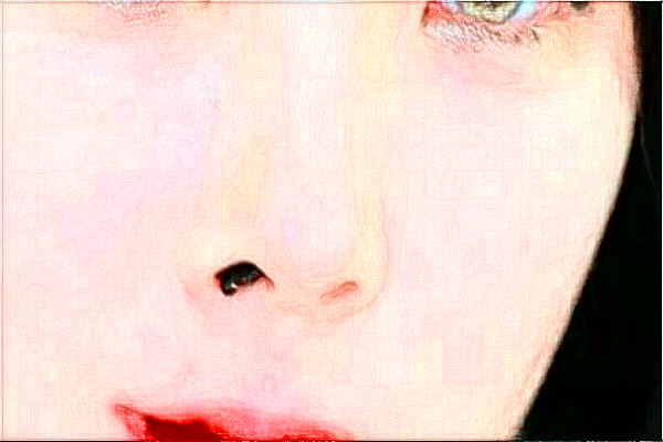 2024天津醫(yī)科大學(xué)總醫(yī)院可以去胎記嗎？去胎記真實案例