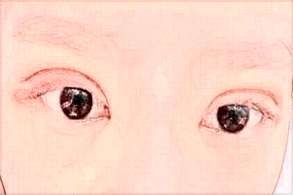 天津醫(yī)科大學總醫(yī)院割雙眼皮做的怎么樣_哪位醫(yī)生技術比較好