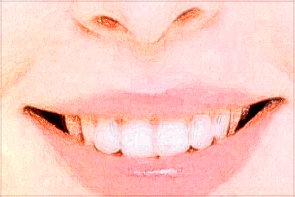 中山大學附屬口腔醫(yī)院種植牙科怎么樣?種植牙的利與弊