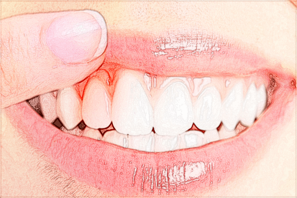 2024蘭州大學第二醫(yī)院洗牙多少錢?洗牙注意事項有哪些