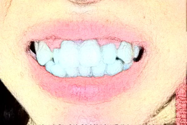 2024河北省人民醫(yī)院牙齒矯正怎么樣_誰做得好