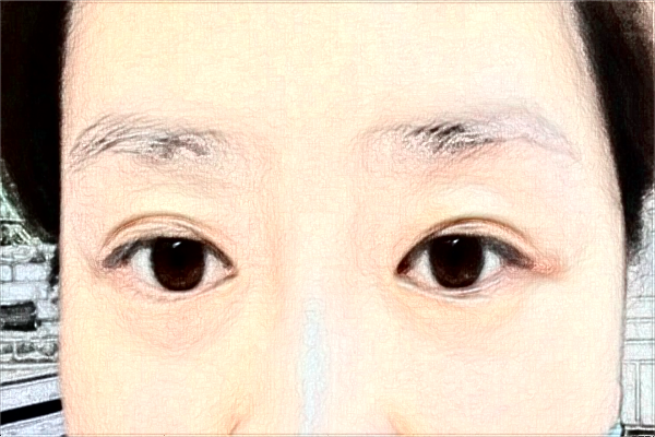 大慶市人民醫(yī)院全飛秒做的好嗎?誰(shuí)做得好