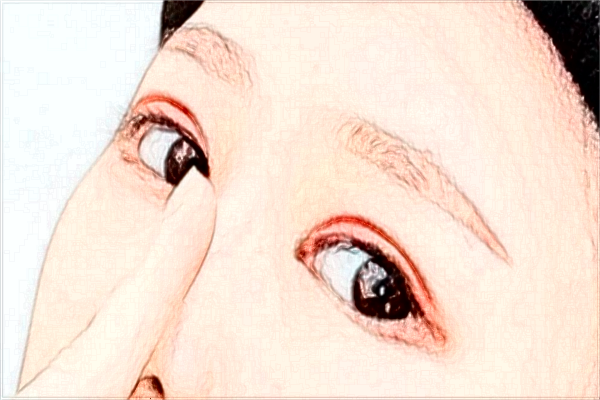 2024安徽省立醫(yī)院填充淚溝需要多少錢?醫(yī)生推薦