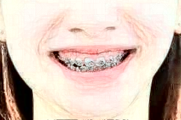 2024南京鼓樓醫(yī)院牙齒矯正價(jià)目表(價(jià)格表)怎么樣