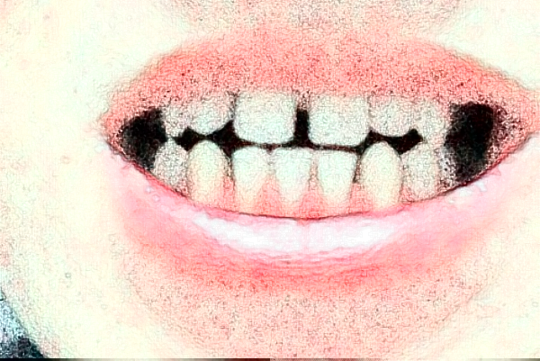 溫州醫(yī)學(xué)院附屬第二醫(yī)院口腔科補(bǔ)牙怎么樣_整形日記分享