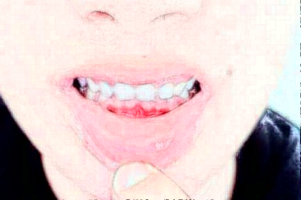 2024安徽省立醫(yī)院牙齒不齊矯正做的怎么樣_哪位醫(yī)生技術(shù)比較好