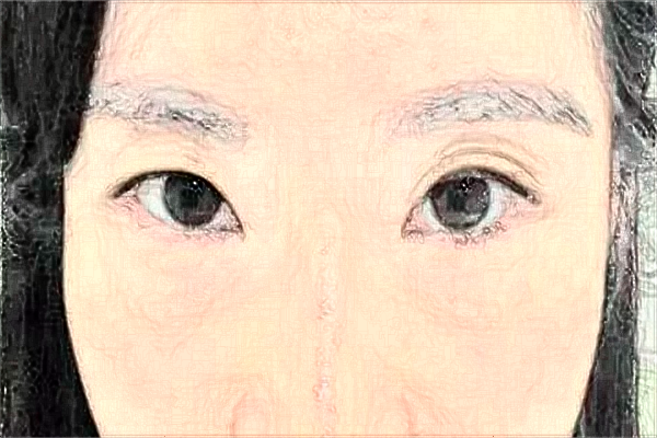 河北省人民醫(yī)院去眼袋需要多少錢(qián)?醫(yī)生推薦