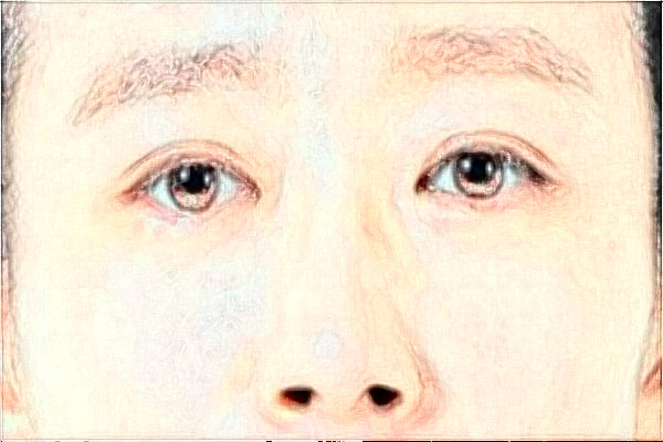 河北省人民醫(yī)院去眼袋需要多少錢(qián)?醫(yī)生推薦