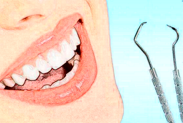 綿陽市中心醫(yī)院牙齒貼面做的好不好?全過程分享