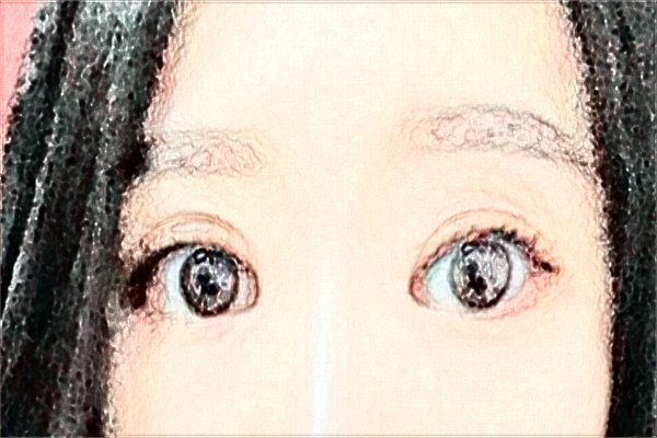 佛山市第二人民醫(yī)院雙眼皮手術好嗎?附雙眼皮案例