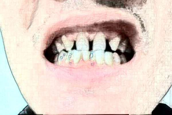 上海華美醫(yī)療美容醫(yī)院牙齒美容好嗎_真實(shí)案例發(fā)布