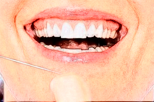 安徽省立醫(yī)院根管加牙冠多少錢?做的好嗎?