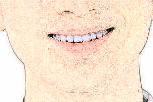 2024青島海慈醫(yī)院補(bǔ)牙多少錢?補(bǔ)牙材料是什么