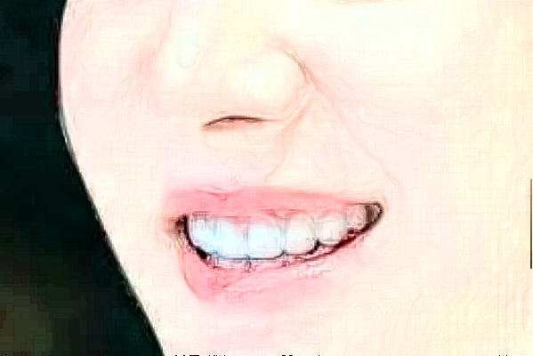 ?？谑腥嗣襻t(yī)院補(bǔ)牙哪個(gè)醫(yī)生好?補(bǔ)牙案例