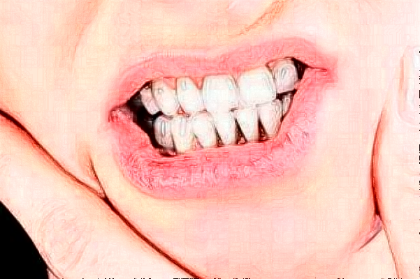 2024安徽醫(yī)科大學(xué)第一附屬醫(yī)院種牙多少錢【種牙案例】