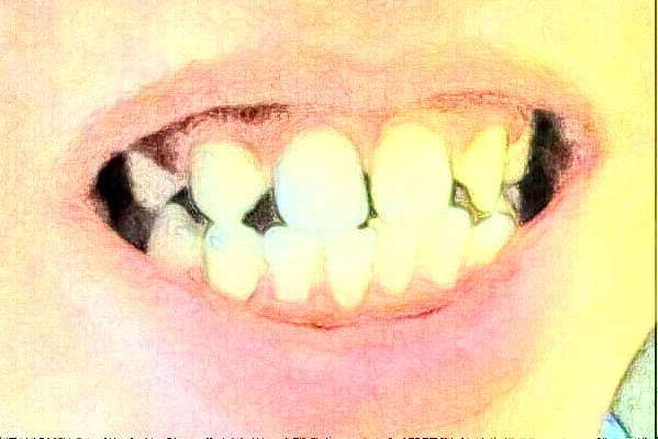 2024安徽醫(yī)科大學(xué)第一附屬醫(yī)院種牙多少錢【種牙案例】