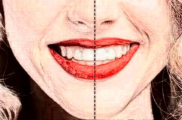 上海華美醫(yī)療美容醫(yī)院樹脂補牙價目(價格)表_怎么樣