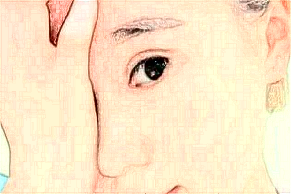 徐州醫(yī)科大學附屬醫(yī)院開眼角怎么樣_整形日記分享