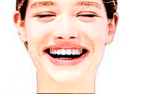 上海華美醫(yī)療美容醫(yī)院瓷貼面好嗎_真實案例發(fā)布