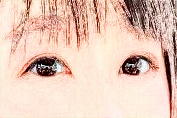 2024煙臺毓璜頂醫(yī)院整形價目表?附割雙眼皮案例