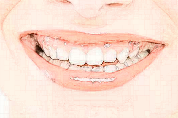 2024??谑腥嗣襻t(yī)院種植牙價(jià)格?種植牙和真牙的區(qū)別