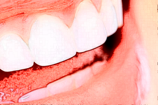 河北大學(xué)附屬醫(yī)院種牙多少錢_真實(shí)案例反饋