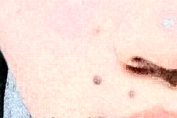 2024沈陽(yáng)盛京醫(yī)院去痣好不好?體驗(yàn)日記反饋