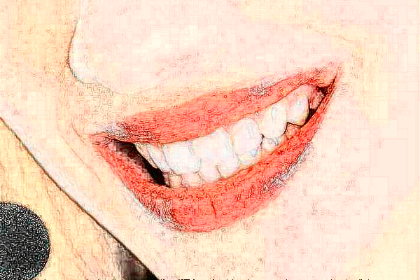 長沙科爾雅口腔醫(yī)院隱形正畸收費(fèi)標(biāo)準(zhǔn),案例變化分享