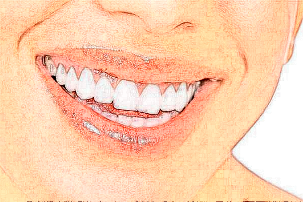 成都圣貝牙科醫(yī)院自鎖矯正價格多少?整形日記全過程分享